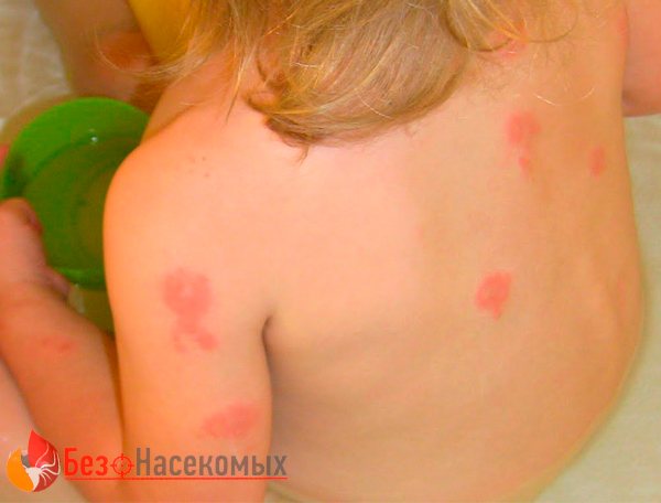 Аллергия на клопов у ребенка