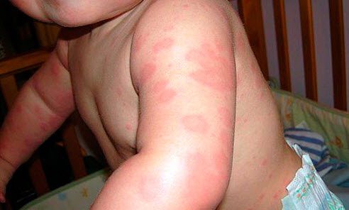 Аллергия на коже ребенка