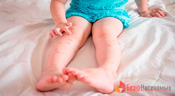 Аллергия на укус клопа у ребенка