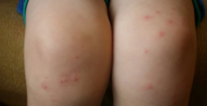 аллергия на укусы блох фото