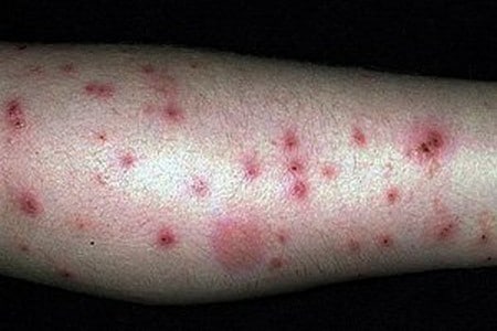 аллергия на укусы клопов у ребенка