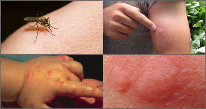 аллергия на укусы насекомых