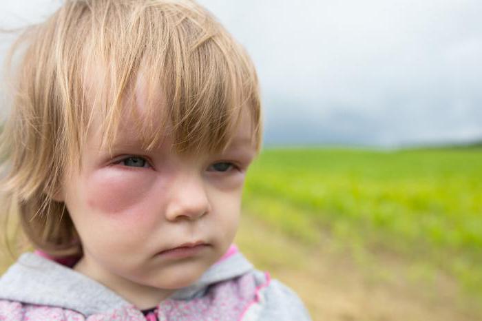 Аллергия от комаров у ребенка
