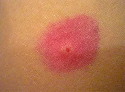 Аллергия у человека на укус блохи