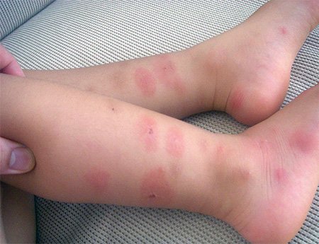 Аллергия у ребенка на клопов