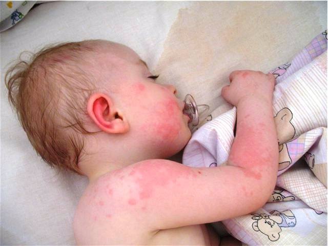 Аллергия у ребенка от укусов клопов