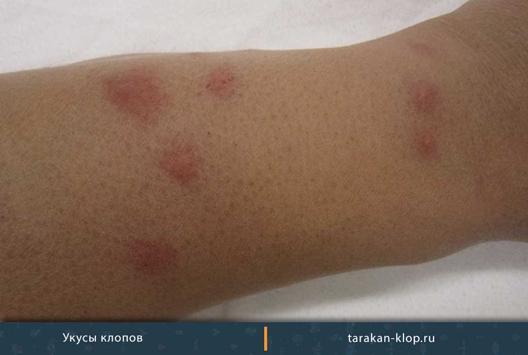 Фото аллергии на укусы клопов на коже человека