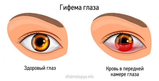 Гифема глаза