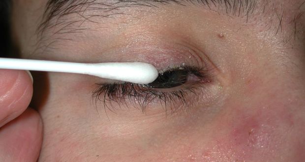 Как производить лечение демодекоза век, ресниц и кожи вокруг глаз