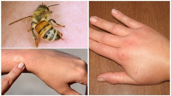 Как выглядят укусы насекомых, фото - кто укусил, последствия