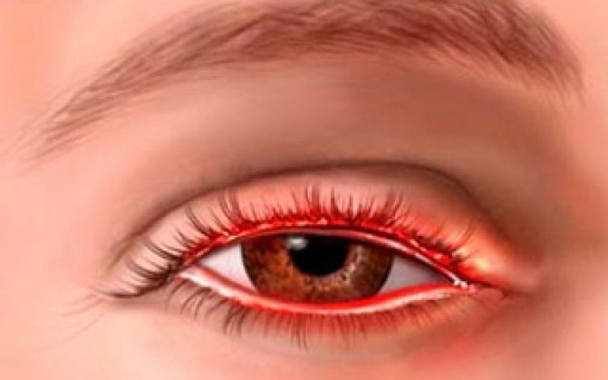 Клещи на ресницах глаз у человека: Демодекоз на ресницах и его лечение