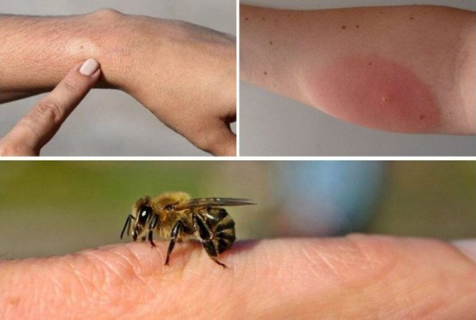 Последствия укуса пчелы